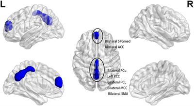 Frequency-Specific Changes in the Fractional Amplitude of the Low-Frequency Fluctuations in the Default Mode Network in Medication-Free Patients With Bipolar II Depression: A Longitudinal Functional MRI Study